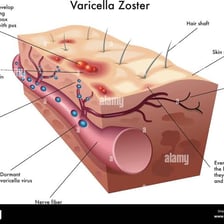 A medical illustration showing the characteristic rash associated with chickenpox.