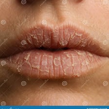 Close-up view of lips showing dryness and cracking