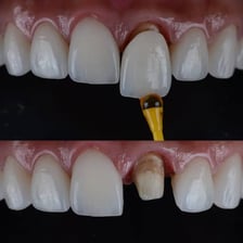 Dentist fitting a crown onto a patient’s tooth