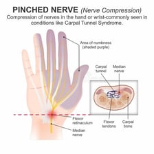 Medical illustration showing reduced sensation in a hand.