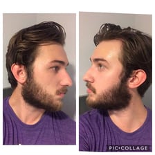 A man showing beard growth extending below the jawline onto the neck.
