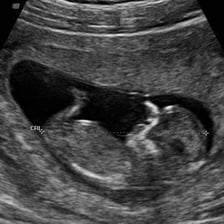 A fetal ultrasound scan showing an unborn baby.