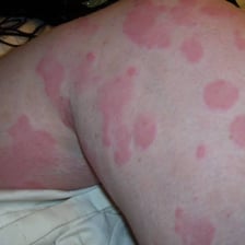 Educational illustration showing irregular red patches on skin