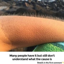 Close-up of skin covered with raised goosebumps.