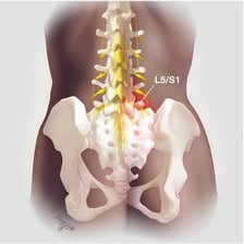 Medical illustration showing the lumbar region associated with lower back pain