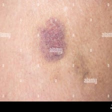 A visible bruise on a person’s skin.