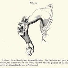 Educational illustration of a surgeon removing tissue during an operation.