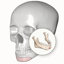 A side-profile illustration highlighting the contour of the lower jaw