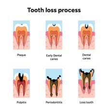 An educational close-up or illustration showing plaque buildup on teeth.