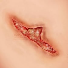 Medical illustration showing several lacerations on the skin