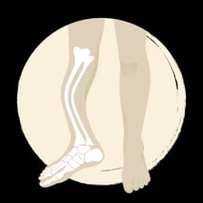 Medical illustration showing a fragile bone with a fracture.