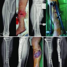 An X-ray showing a fracture in a human leg bone