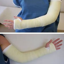 A person’s arm supported in a plaster cast after a fracture