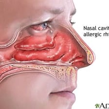 A medical illustration showing inflamed nasal passages.