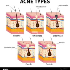 A medical-style illustration of a skin pimple.