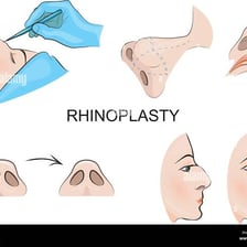 A medical illustration depicting rhinoplasty of the nose.