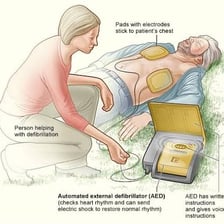 A portable automated external defibrillator with electrode pads.