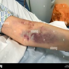 A person gently touching a bruised and sore arm