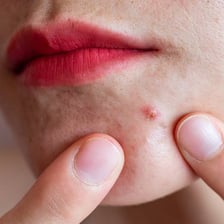 Close-up view of a pimple on facial skin