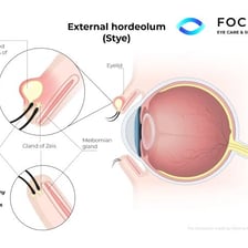 Medical illustration showing a stye on an eyelid