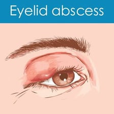 A medical illustration showing a stye on an eyelid.