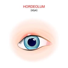 A close-up medical illustration of a stye on an eyelid