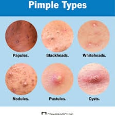 A close-up showing a small pimple on skin.