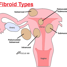 An anatomical illustration of a uterus as seen in an ultrasound context.