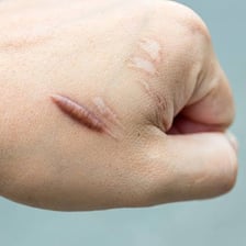 A healed scar on human skin
