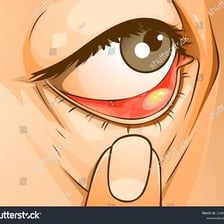 A medical illustration showing a stye on the edge of an eyelid