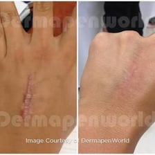 A visible healed scar on a person’s skin.
