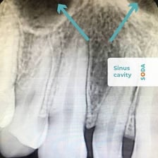 A dental radiograph showing teeth and jawbone