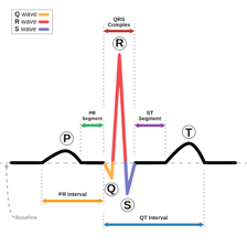 An electrocardiogram tracing a heartbeat