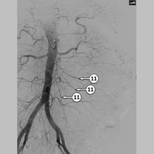 A medical angiogram showing the aorta.
