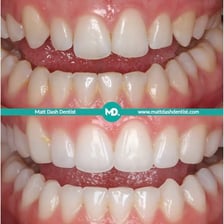 A close-up of a human smile showing the pointed canine teeth.