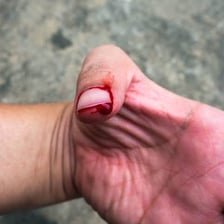 Small cut on a finger being treated with first aid