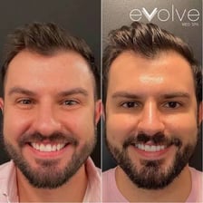 A skincare professional applying a facial chemical peel.