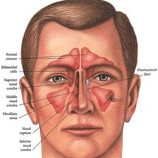 A medical diagram labeling the sinus cavities in the human head.