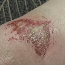 A scraped knee with a scab forming over the healing skin.