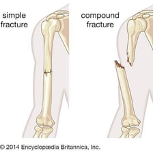 An educational illustration of a bone separated into broken pieces