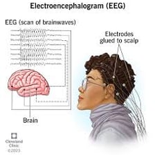 A patient undergoing an EEG with electrodes attached to the scalp