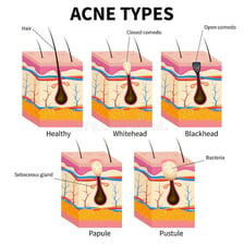 A close-up educational view of a pimple on skin