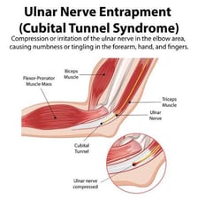 An anatomical illustration showing the ulnar nerve near the elbow