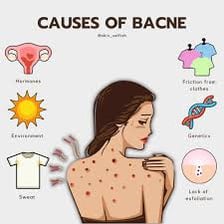 Simple educational illustration showing the term bacne formed from back and acne