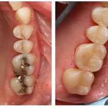 Rusted metal nails shown beside clean, healthy teeth.