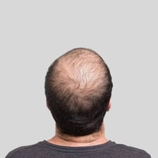 A man with some hair loss on the top of his head.