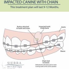 A dental retainer shown near an illustration of a canine tooth.