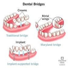 Dental bridge replacing missing teeth in a model jaw