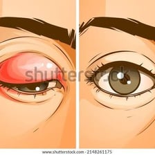 Medical illustration showing a stye on an eyelid