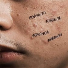 A close-up view of a small acne blemish